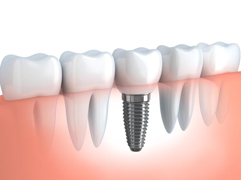 Dental Implants in Moberly, MO