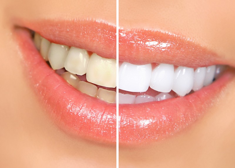 teeth whitening services in Moberly, MO