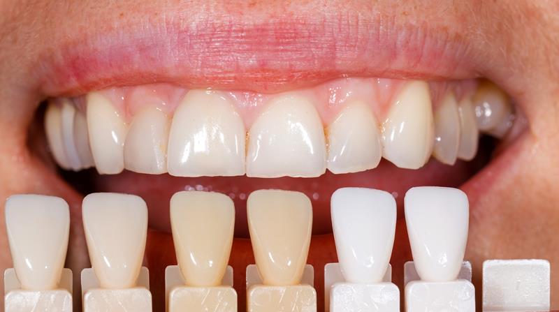 Veneers in Moberly, MO